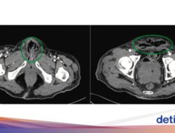 Alat Kelamin Pria Ini Harus Diamputasi gegara Membusuk, Ini Sebabnya