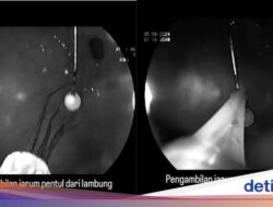 Detik-detik Praktisi Medis Senior FKUI Keluarkan Jarum Pentul Di Lambung